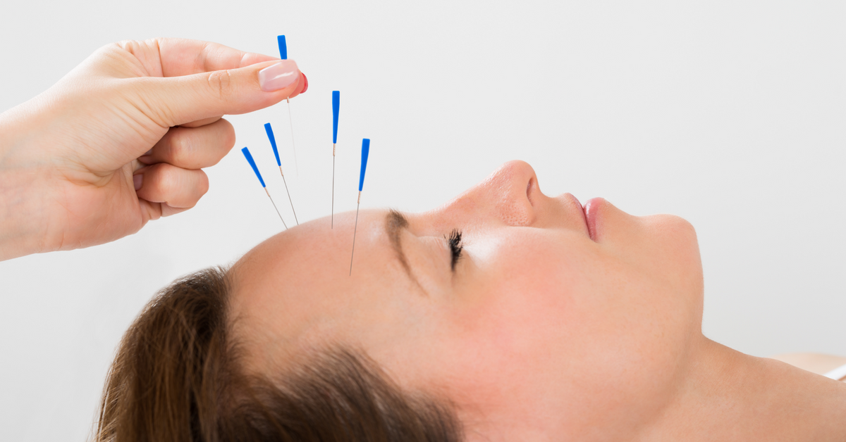 Acupuncture Therapy for Rheumatoid Arthritis and Headache Treatment